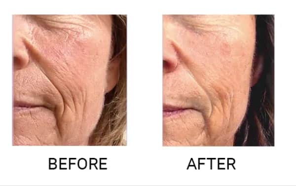 Endermologia twarzy: Naturalny lifting bez skalpela. Efekty, cena.