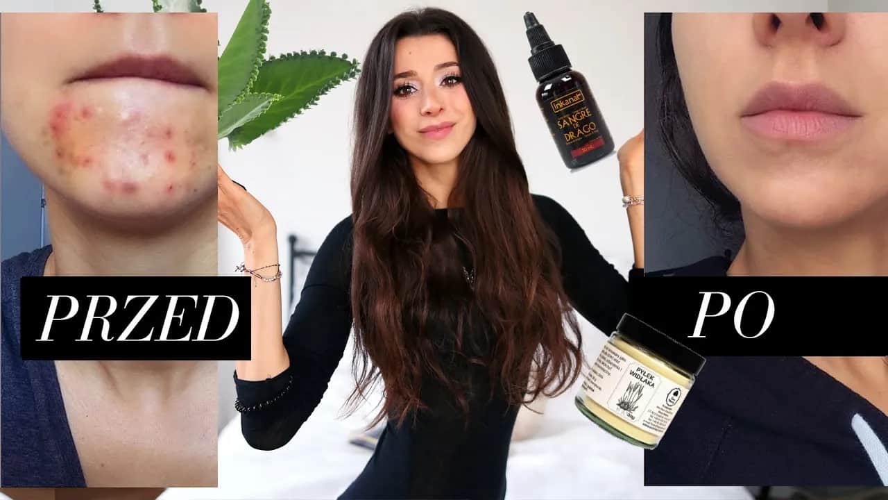 Pryszcze? Odkryj, co naprawdę działa! Domowe i apteczne sposoby