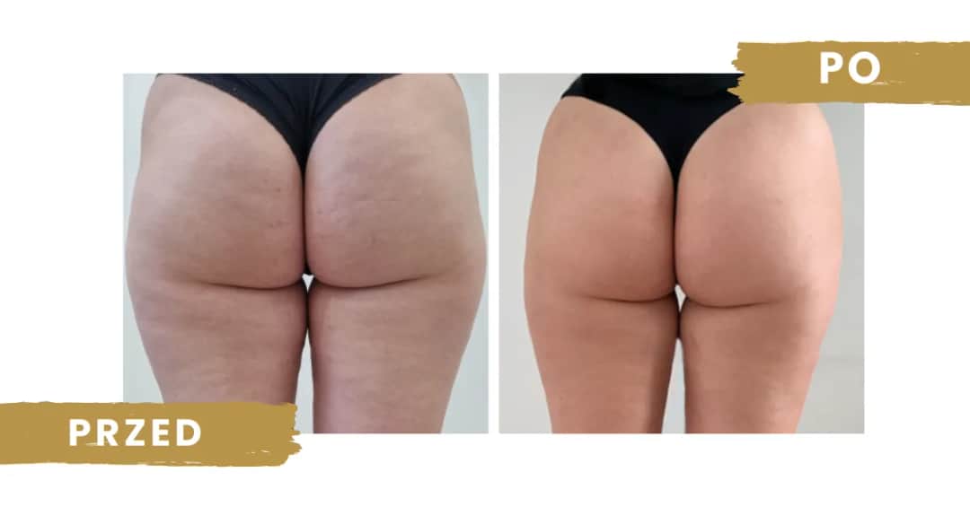 Endermologia czy warto? Szczera ocena efektów, kosztów i ryzyk.