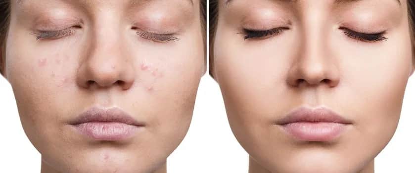 Jak usunąć czerwone ślady po pryszczach? Poradnik eksperta