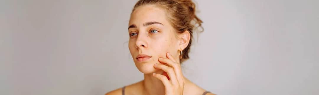 Jak przestać wyciskać pryszcze? Koniec z bliznami i przebarwieniami.