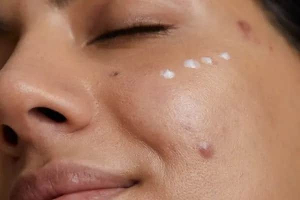 Bolesny pryszcz podskórny? Poznaj plan działania krok po kroku