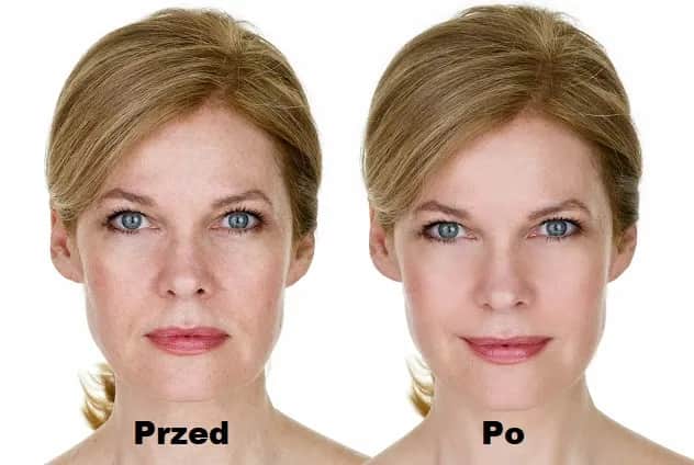 Efekty botoksu: Kiedy zobaczysz zmianę i jak długo potrwa?