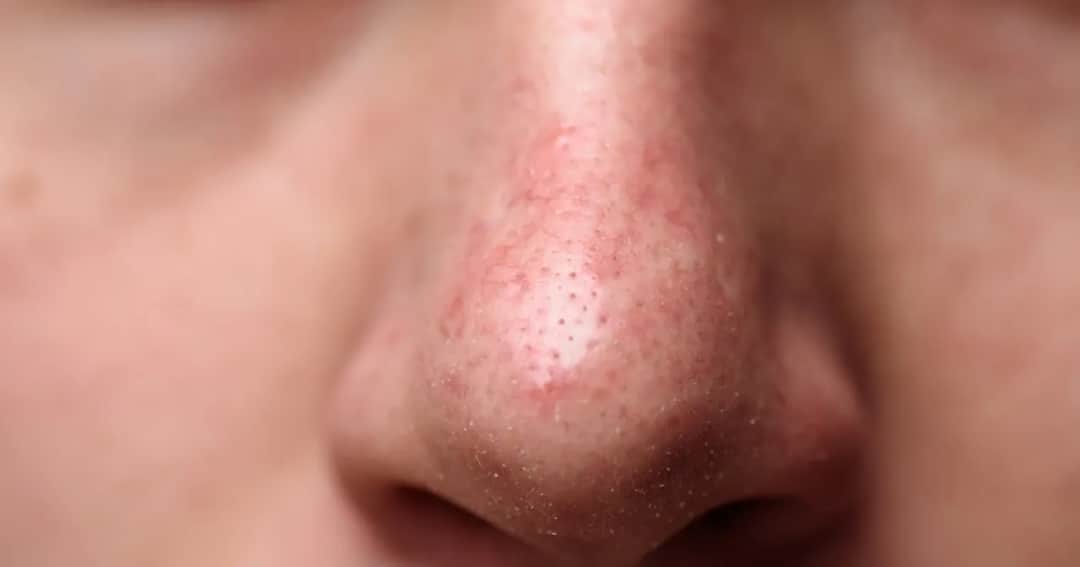Pryszcze na nosie: Dlaczego powstają i jak się ich skutecznie pozbyć?
