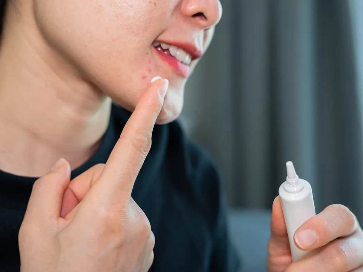 Pasta do zębów na pryszcze? Ile trzymać i dlaczego to mit!